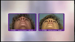Before and after photo of a deviated septum