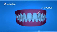 Big teeth and gums about invisalign teeth orthodontics