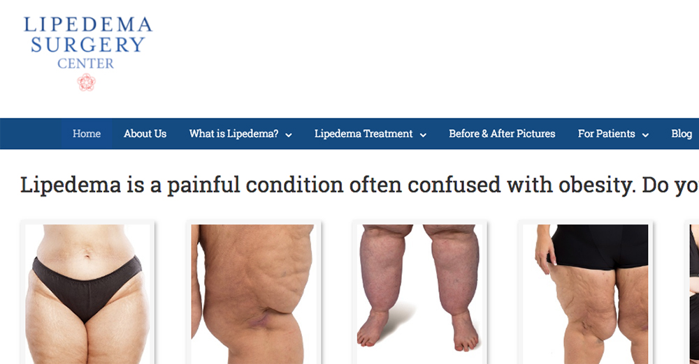 photo of The Lipedema Surgery Center website | Dr. Marcia Byrd